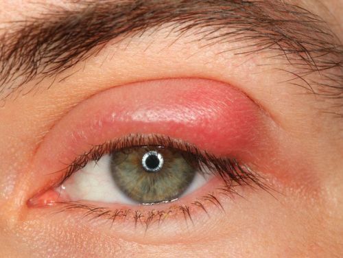 Болит глаз при моргании, нижнее веко, уголок глаза - что делать?