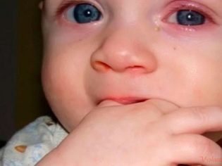 Воспаление века глаза: как его лечить? Лечение верхнего и нижнего века у ребенка