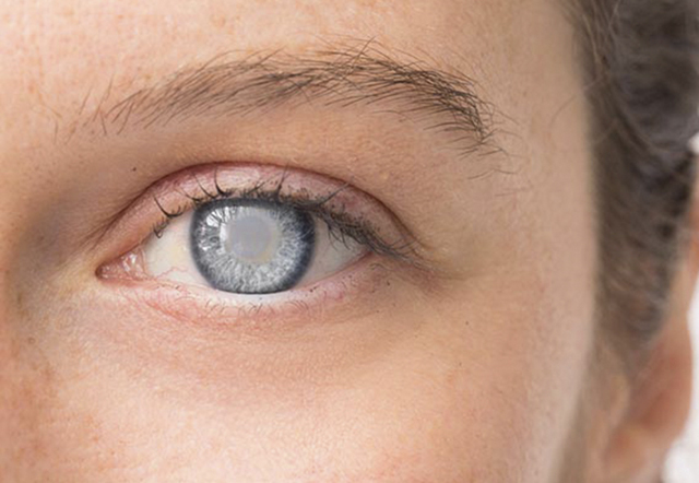 Как лечить катаракту в домашних условиях народной медициной