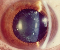 Хрусталик глаза: заболевания, функции, строение хрусталика глаза