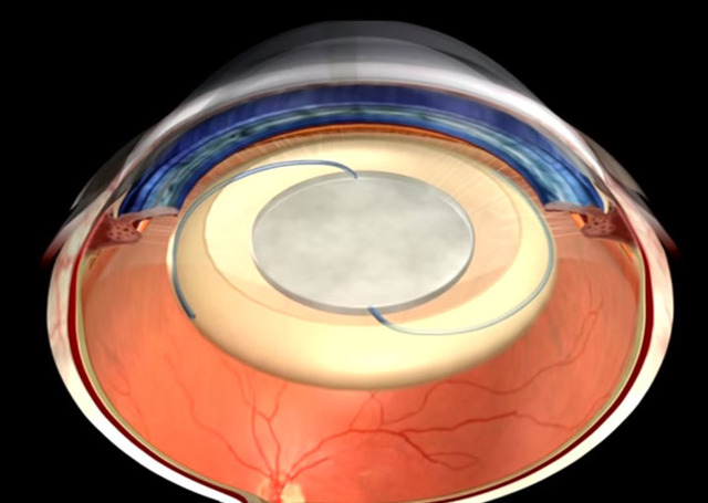 Факоэмульсификация катаракты с имплантацией ИОЛ - что это такое? Осложнения после операции