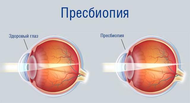 Почему падает зрение после 40 лет, возрастные изменения зрения - ухудшение
