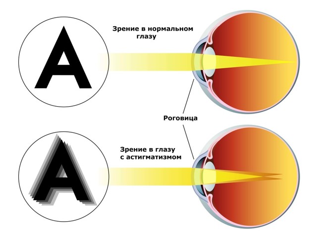 Последствия после лазерной коррекции зрения - ухудшение и осложнения, почему упало зрение и появилась мутность в глазах