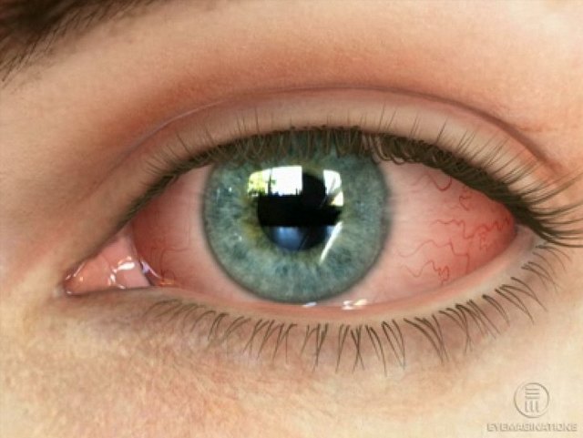 Конъюнктивит глаз: признаки, симптомы и лечение конъюнктивита