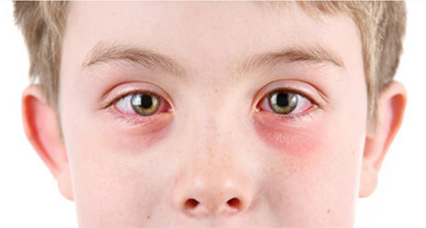Аллергический конъюнктивит у детей, симптомы и лечение у ребенка