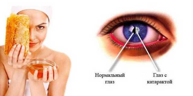 Лечение катаракты глаз: оперативное, витамины, консервативное, упражнения