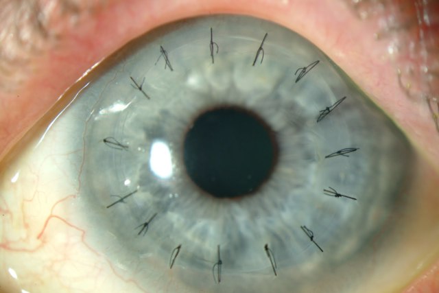 Стадии возрастной катаракты: начальная, незрелая катаракта, зрелая, перезрелая