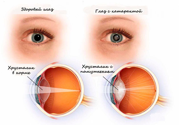 Хрусталик глаза: заболевания, функции, строение хрусталика глаза