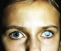 Бельмо на глазу, помутнение роговицы глаза: причины и лечение