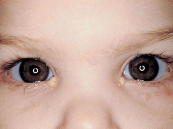 Желтые и белые выделения из глаз у ребенка, новорожденного грудничка
