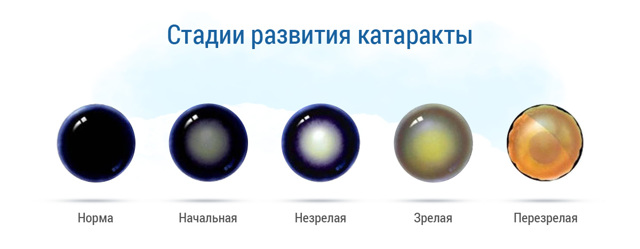 Стадии возрастной катаракты: начальная, незрелая катаракта, зрелая, перезрелая