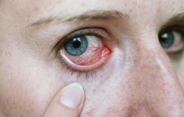Осложнения после операции катаракты глаз: отек роговицы, астигматизм, болит глаз, не видит