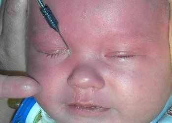 Почему закисает глазик у новорожденного, что делать?