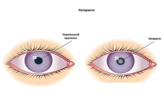 Сколько длится операция катаракты по времени?