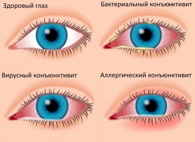 Хронический конъюнктивит глаз: лечение и симптомы у взрослых