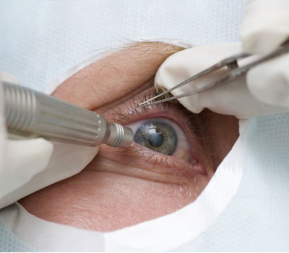 Катаракта: операция, противопоказания после удаления катаракты глаза
