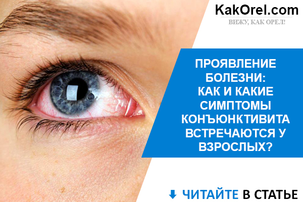 Конъюнктивит глаз: признаки, симптомы и лечение конъюнктивита