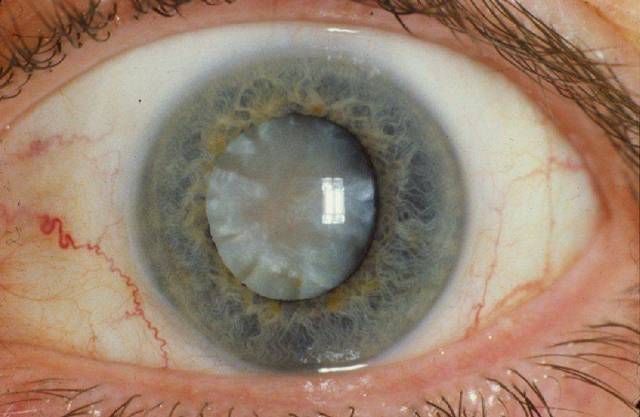 Когда делать операцию на катаракту? Нужно узнать лучше у врача про удаление катаракты