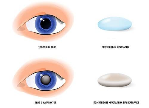 Искусственный хрусталик глаза - срок службы, виды искусственных хрусталиков, их преимущества и недостатки