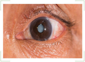 Начальная катаракта - лечение начальной стадии катаракты