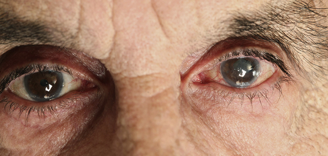 Катаракта: операция пожилого человека, последствия удаления катаракты для пенсионеров
