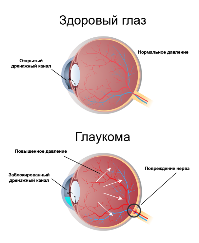 Глаукома глаза - причины, симптомы, профилактика и лечение