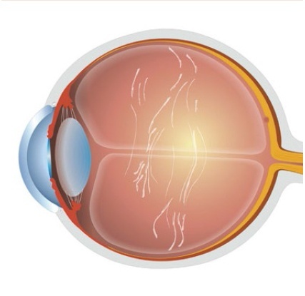 Деструкция стекловидного тела (ДСТ) и синдром сухого глаза (ССГ)