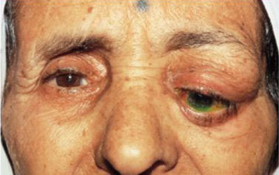 Шишка на верхнем или нижнем веке глаза - причины и лечение