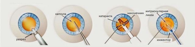 Цены на операцию катаракты с установкой EDOF и мультифокальных ИОЛ