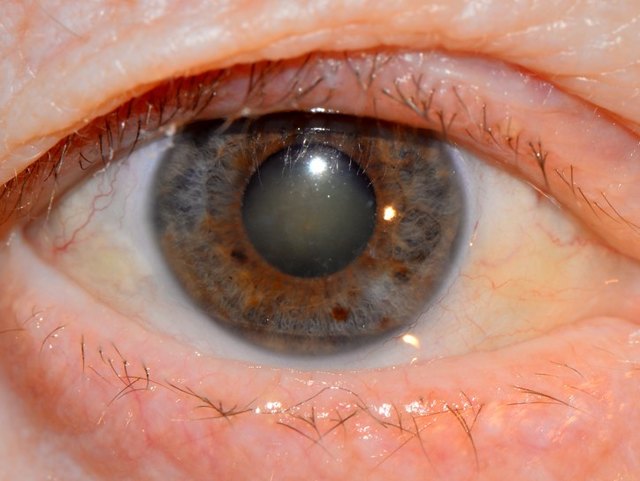 Снижение зрения через несколько лет после удаления катаракты