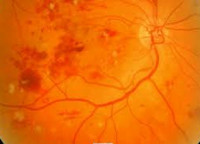 Диабетическая ретинопатия сетчатки глаз - классификация (стадии) ретинопатии, симптомы и методы лечения