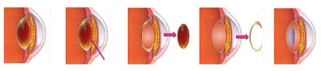 Интракапсулярная экстракция катаракты (ИЭК) - операция по замене хрусталика при катаракте