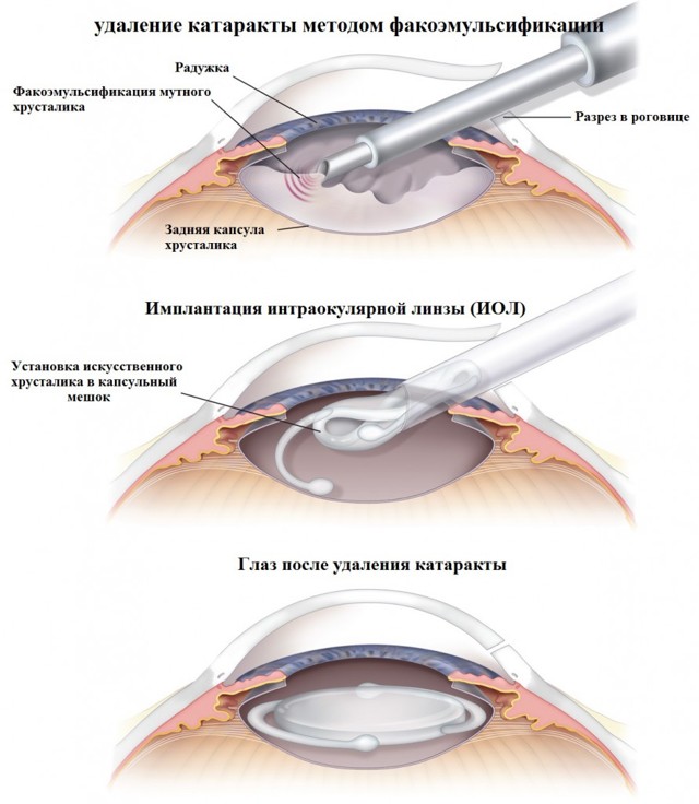 Когда лучше делать операцию при катаракте