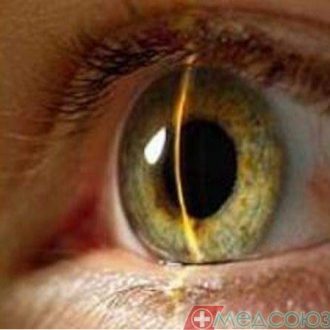 Хирургическое лечение врождённой катаракты и глаукомы у взрослого человека