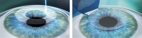 Лазерная коррекция зрения при близорукости - методы лазерной коррекции, отзывы и цены
