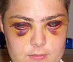 Контузия (ушиб) глаза: симптомы и лечение, степени и негативные последствия