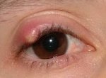 Внутренний ячмень на верхнем или нижнем веке глаза - причины и лечение
