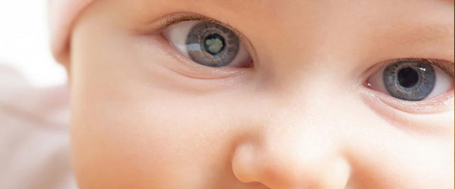 Коррекционные очки у ребёнка после удаления врожденной катаракты