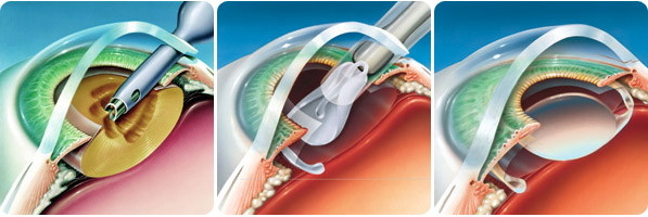 Хорошие и лучшие искусственные хрусталики (интраокулярные линзы) при катаракте