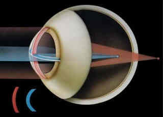 Смешанный астигматизм обоих глаз - возможна ли лазерная коррекция зрения?