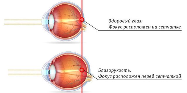 Восстановление зрения при близорукости -2 - аппараты и операция