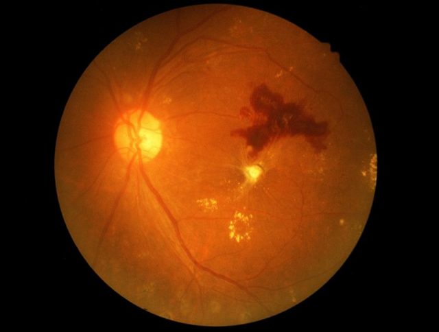 Заболевания роговицы глаза: воспалительные, дистрофические и врожденные и их лечение
