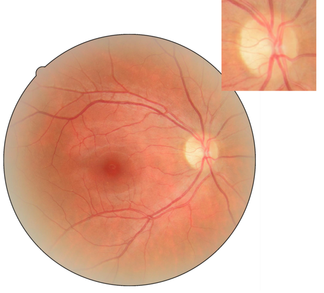 Реваскуляризация заднего отдела глаза при атрофии зрительного нерва, дистрофии сетчатки