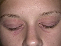 Покраснение кожи вокруг глаз после ячменя - что делать?