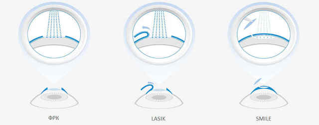 LASEK - лазерная субэпителиальная кератэктомия - преимущества операции, отзывы и цены!