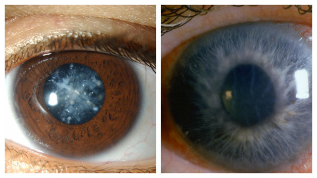 Артифакия обоих глаз и глаукома - что делать
