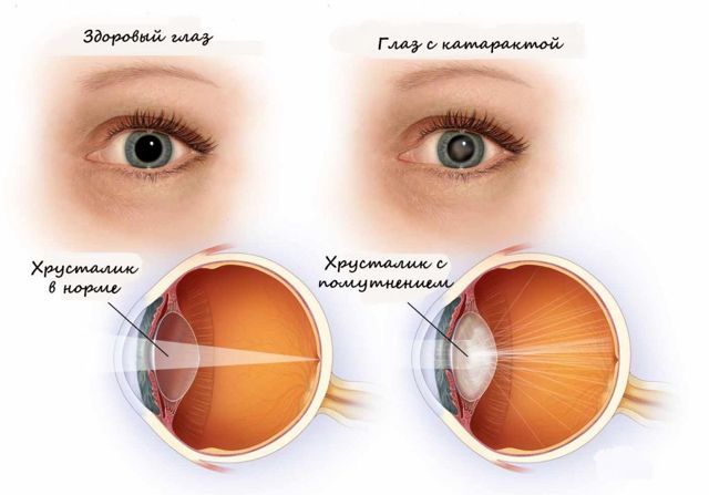 Полярная катаракта - что это такое (особенности, причины и лечение)
