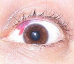 Рубец и кровоизлияние на сетчатке глаза - что делать?