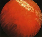 Лечение халязиона и ПВХРД сетчатки глаза