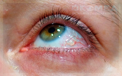 Киста конъюнктивы глаза: причины, симптомы и эффективные методы лечения заболевания